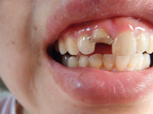 牙齿受外力缺损还能补吗,意外把牙摔坏了