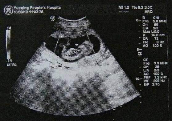 b超单显示的预产期准吗,b超单上的孕周咋算的