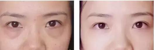 去眼袋15年后有细纹怎么办,祛眼袋之后会不会看着很平