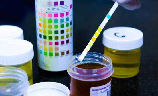 排尿黄异味很大是什么原因,排尿很黄还有分泌物怎么回事