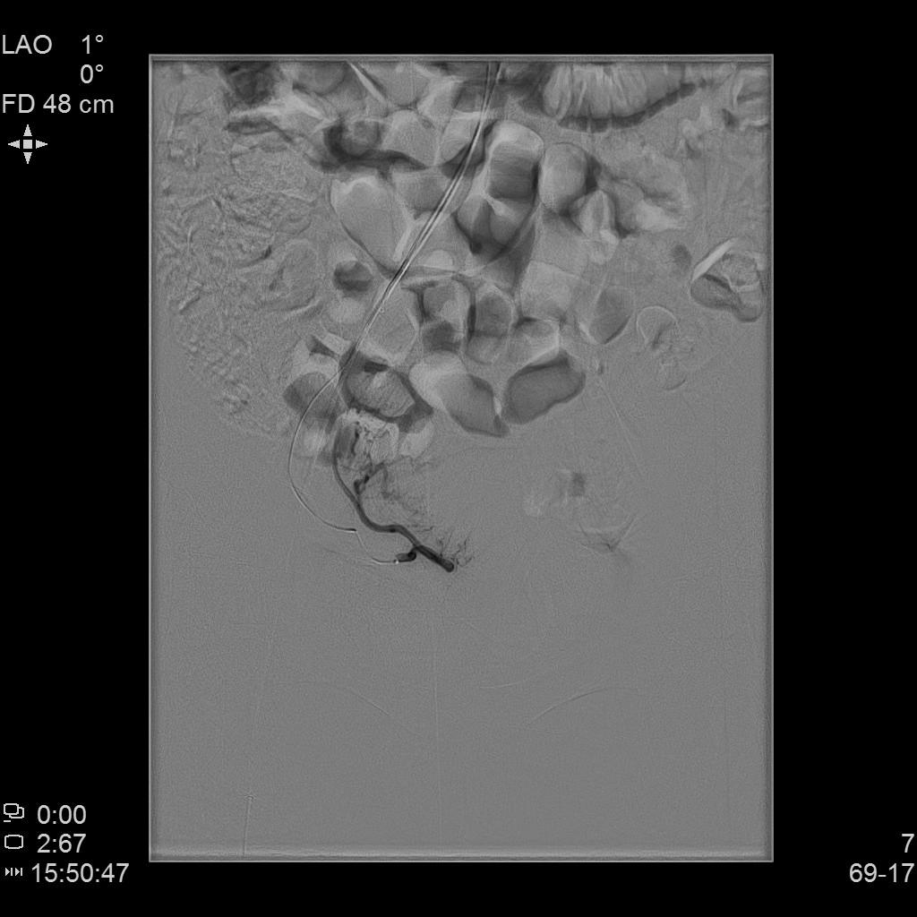 子宫腺肌症「不死的癌症」——介入栓塞来帮忙