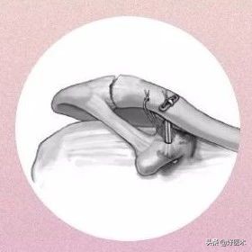 治疗肩锁关节脱位，有最好的方法吗？