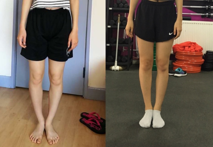 o型腿很难矫正吗,膝关节炎导致o型腿的原因