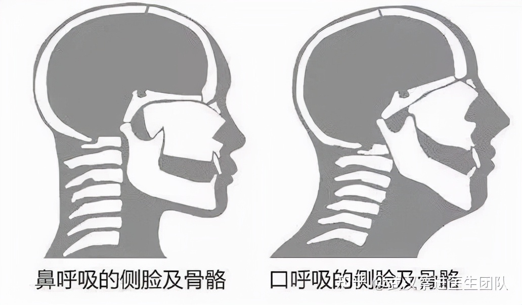 武汉牙齿反颌矫正最佳方案,牙齿矫正可以改善口呼吸面容吗