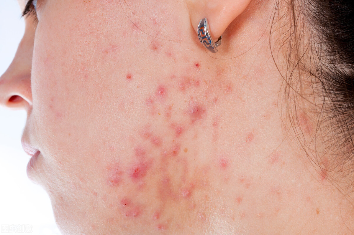 痤疮瘢痕的激光治疗之点阵激光,点阵激光治疗凸起的瘢痕