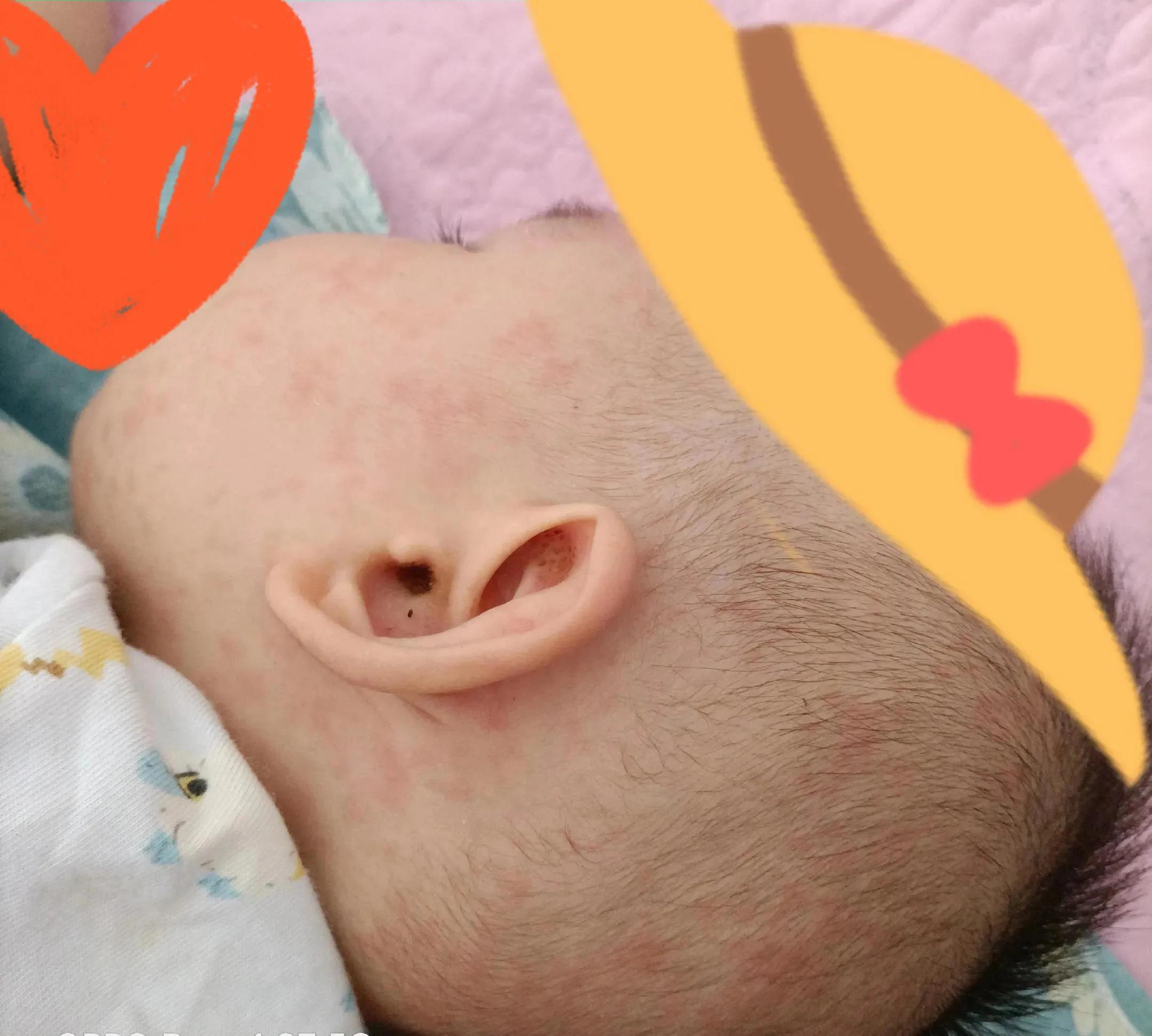 宝宝幼儿急疹出疹后为啥还发烧,宝宝出现幼儿急疹最高发烧多少次