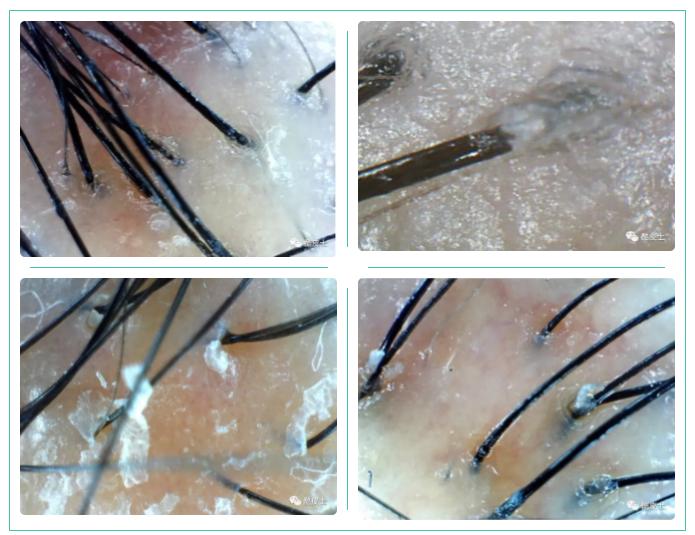 清洗头皮毛囊会长头发么,头皮毛囊清理洗头方法