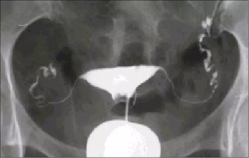 子宫肌瘤手术后对备孕有影响吗,子宫肌瘤患者怀孕了该怎么办