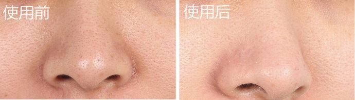 去黑头完了如何修复,去黑头省钱攻略