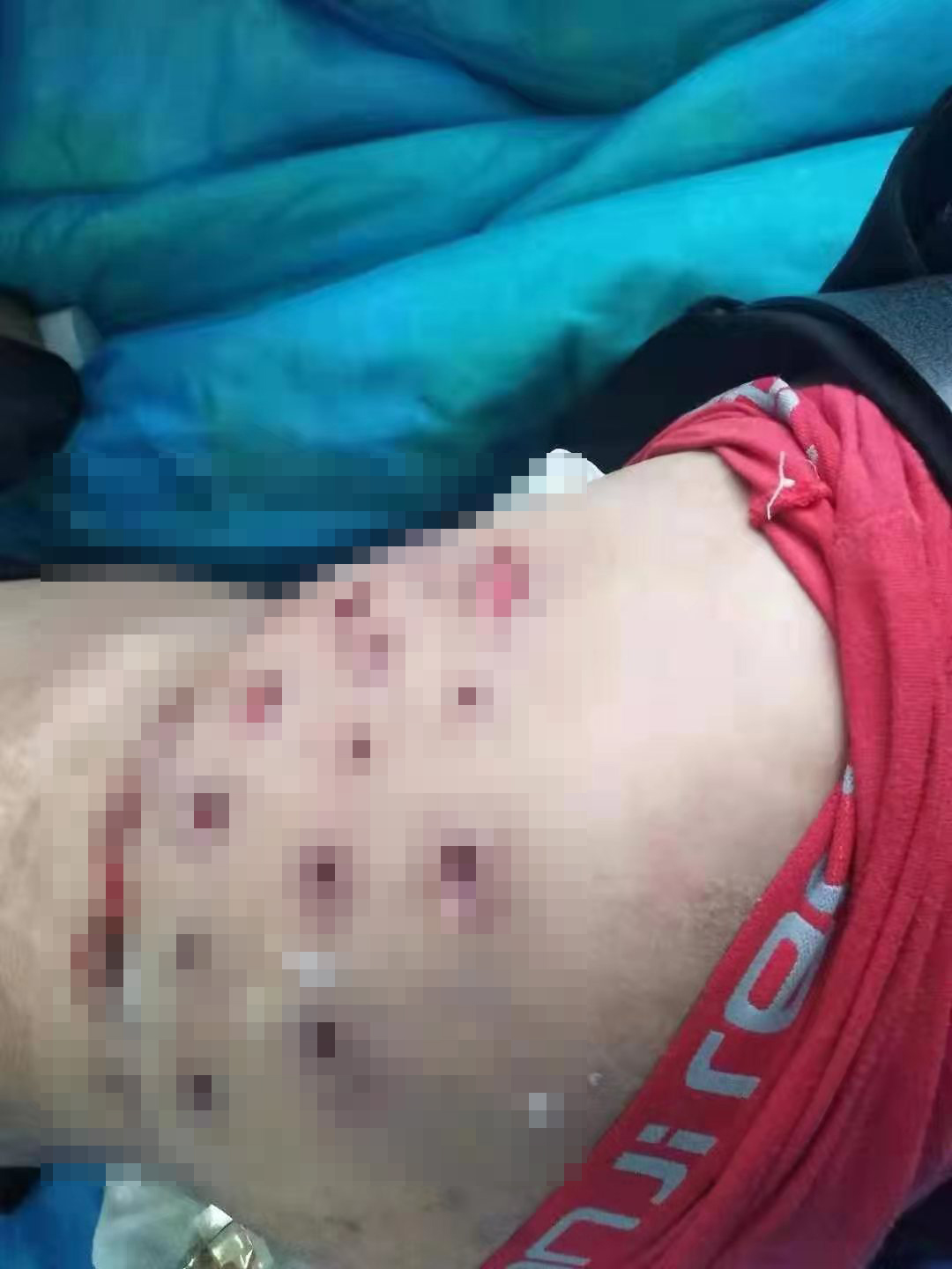 小诊所针灸出现医疗事故怎么处理,扎针灸医疗事故