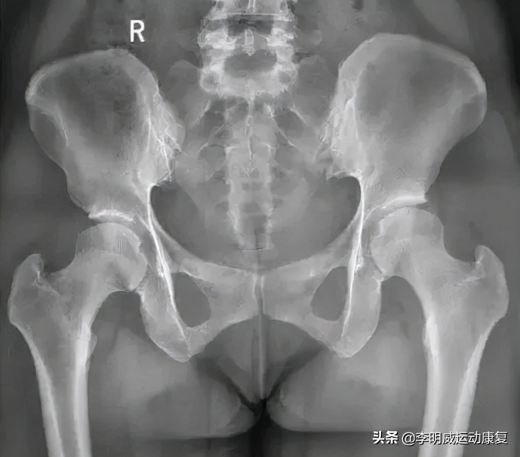 骨盆不正的危害动画视频,骨盆不正危害图片