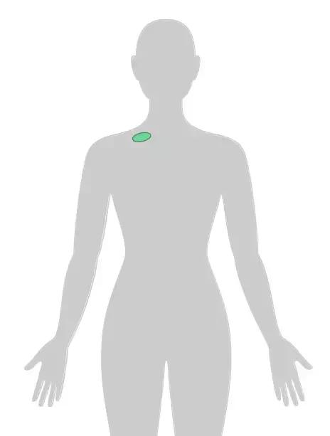四个早期症状告诉你得了癌症,四种情况你有癌细胞