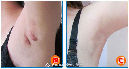 夏天疤痕治疗怎么做,多年疤痕秋冬疤痕痒怎么消除