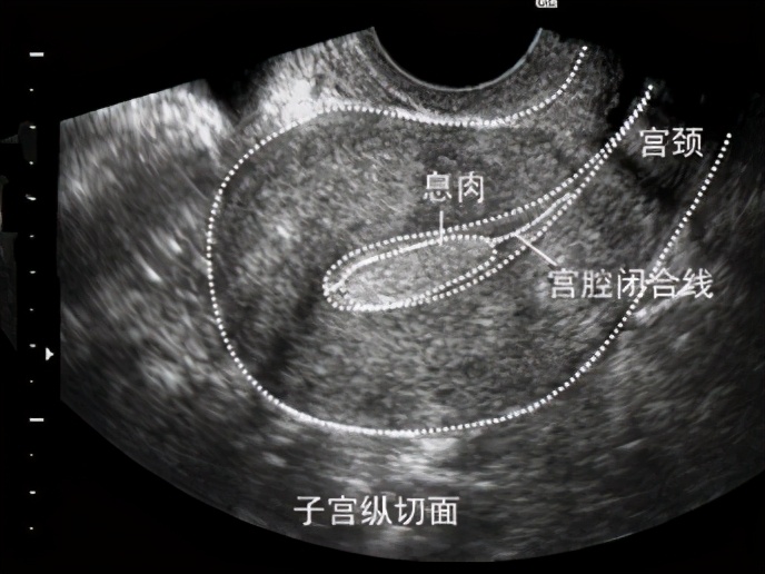 子宫内膜息肉是怎么回事呢,子宫内膜息肉是怎么引起