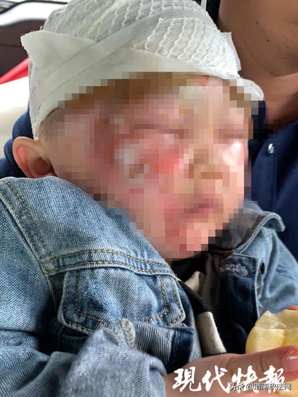 2岁男孩被开水烫伤手起泡几天好,烫伤了越来越肿正常情况多久消肿