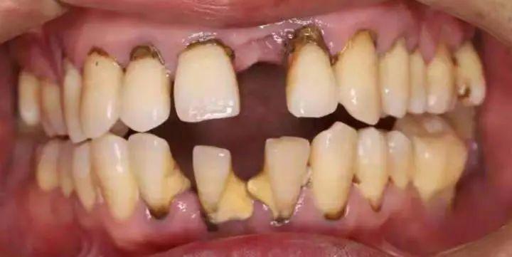 年纪轻轻的掉牙齿是怎么回事,年纪轻轻牙齿掉了