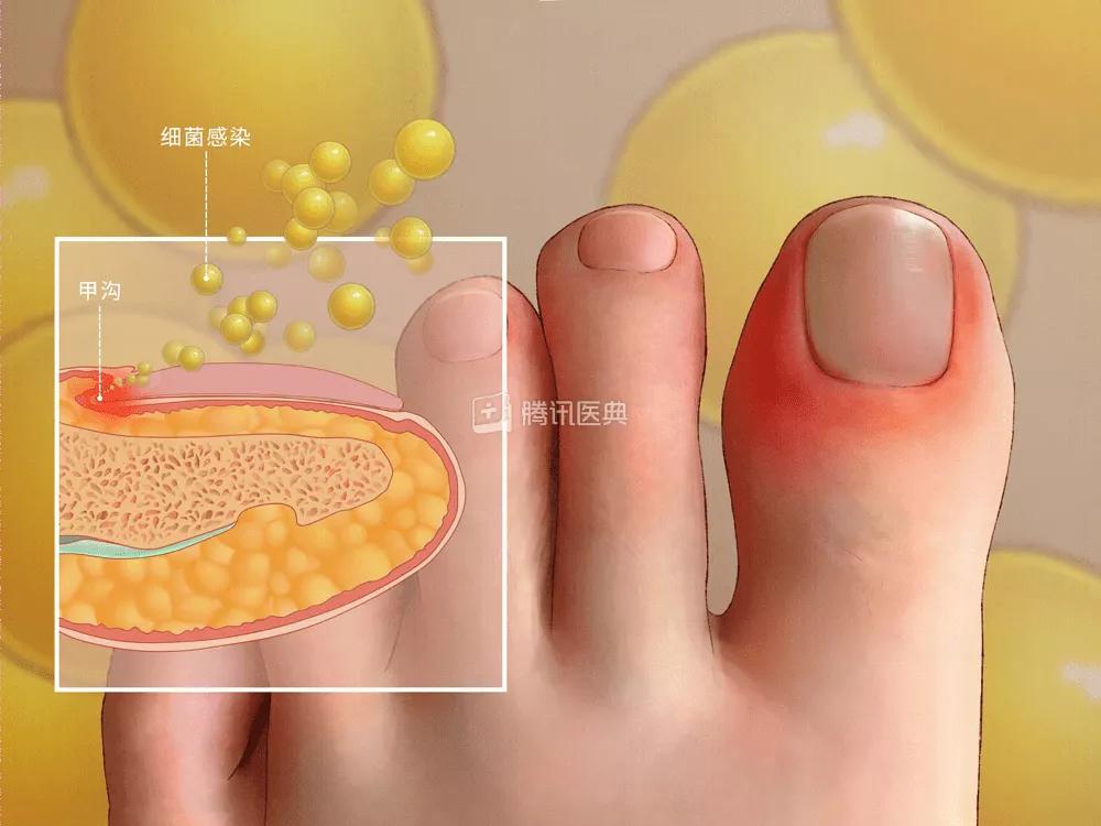 得了甲沟炎太疼了怎么办,甲沟炎疼痛难忍最有效办法