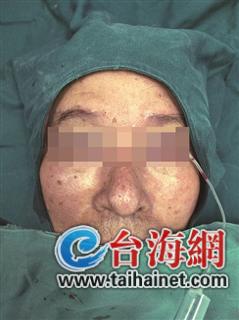 儿童上眼睑下垂矫正术后恢复图片,老年人上眼睑下垂手术图片