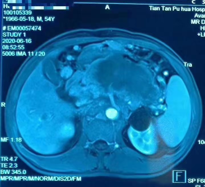 胰腺癌腹膜后多发淋巴转移严重吗,胰腺癌肝内多发转移可以放疗吗