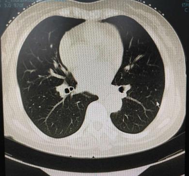 50岁女肺部8毫米结节治疗过程,女士肺结节康复