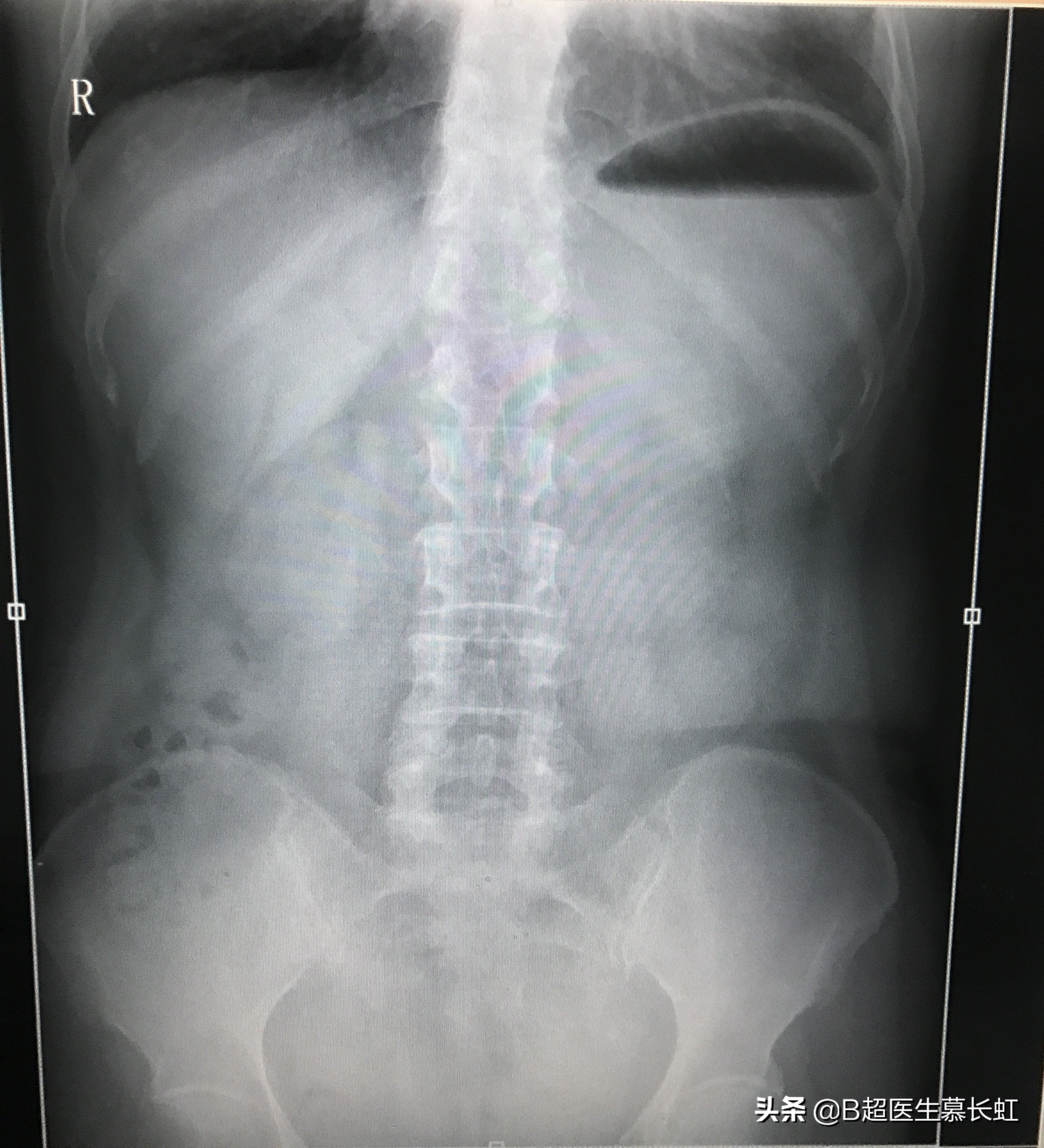 结石山楂可以吃吗,山楂容易长结石吗