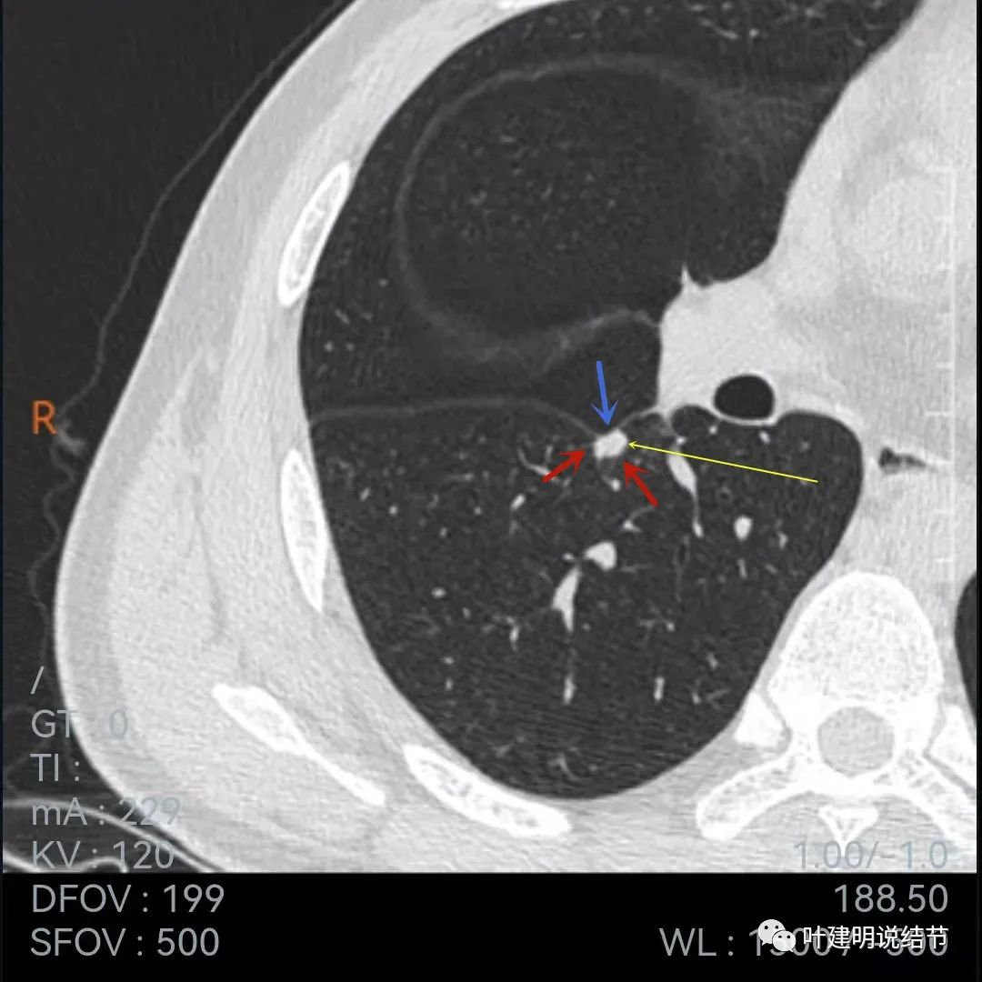 问诊分析:存在了4年的实性结节会不会是肺癌?