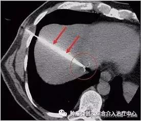 栓塞加消融能根治早期肝癌吗,西安肝癌介入治疗