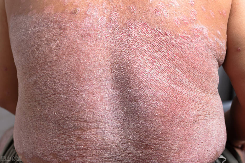 皮肤保湿，在银屑病的治疗过程中非常关键！2个方面一定要做到