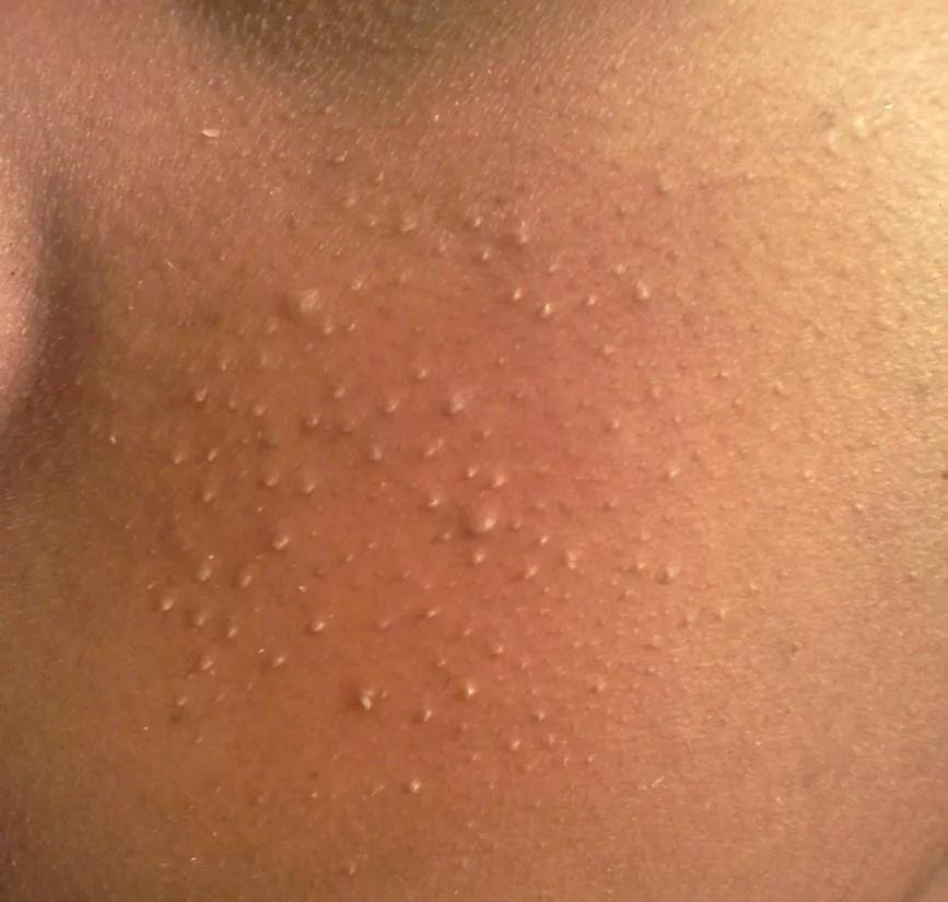 长闭口粉刺黑头的正确消除方法,脸上的粉刺黑头小疙瘩怎么去