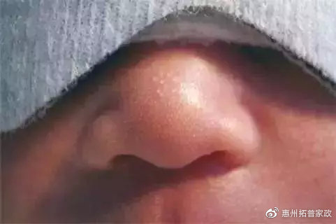 婴儿尿布湿疹的最快自愈方法,婴儿湿疹痤疮尿布疹