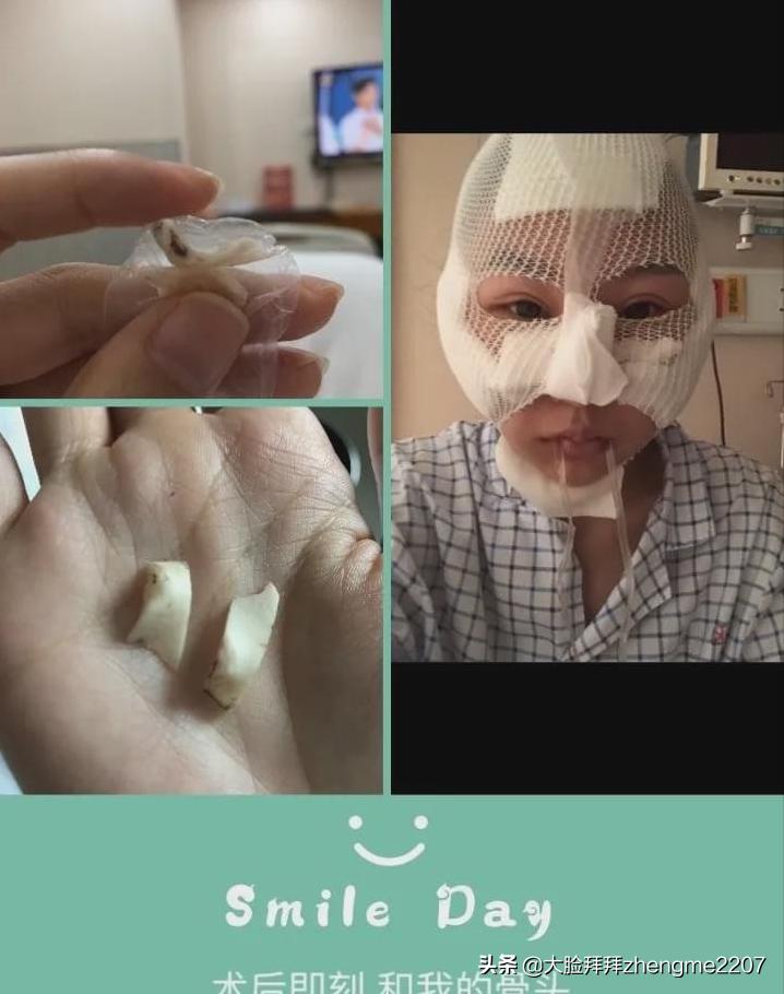 颧骨颧弓内推手术全过程真人,颧骨内推颧弓手术恢复全过程分享