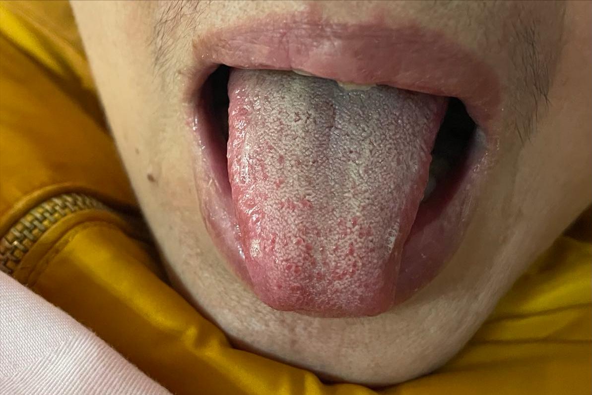 带状疱疹吃中药好还是西药好,带状疱疹后遗神经痛的中药方