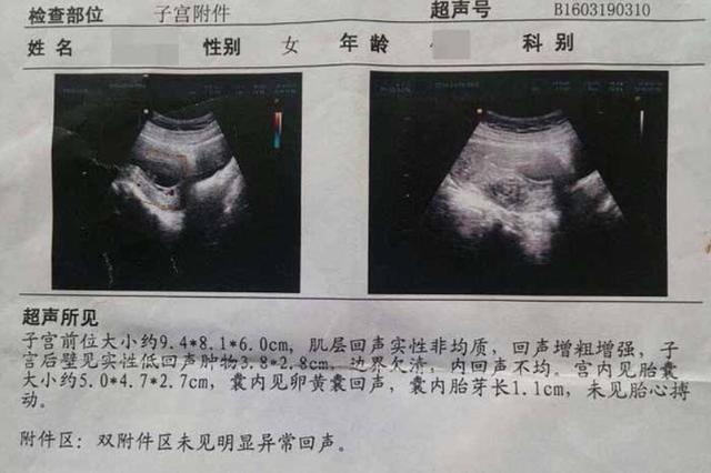 没有胎心是什么原因造成的胎停,为什么第一胎胎停不建议查原因