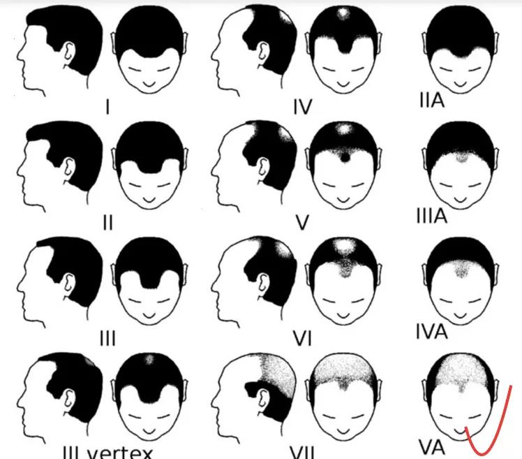 小贝为何剃光头,贝克汉姆的头秃