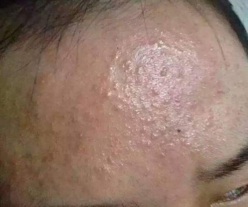 闭合性粉刺如何彻底根治,闭合性粉刺怎么才能根除