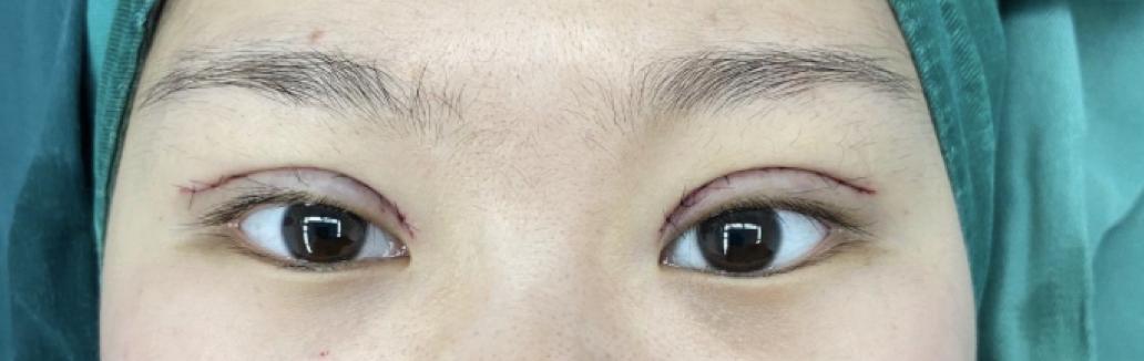 双眼皮手术详细教程,埋线双眼皮手术全过程