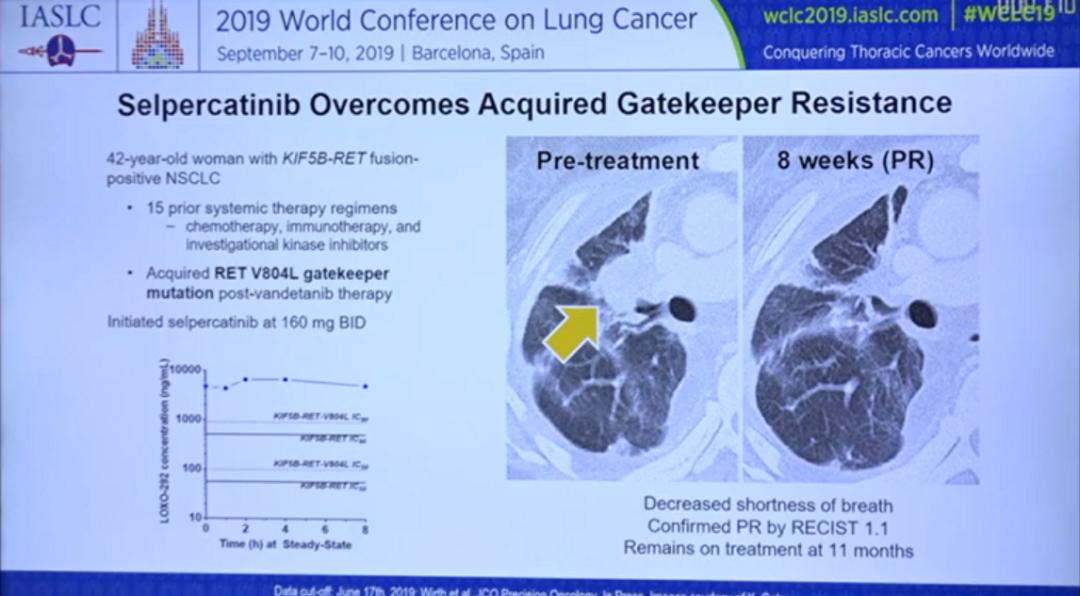 非小细胞肺癌指南最新版本,非小细胞肺癌治疗热点