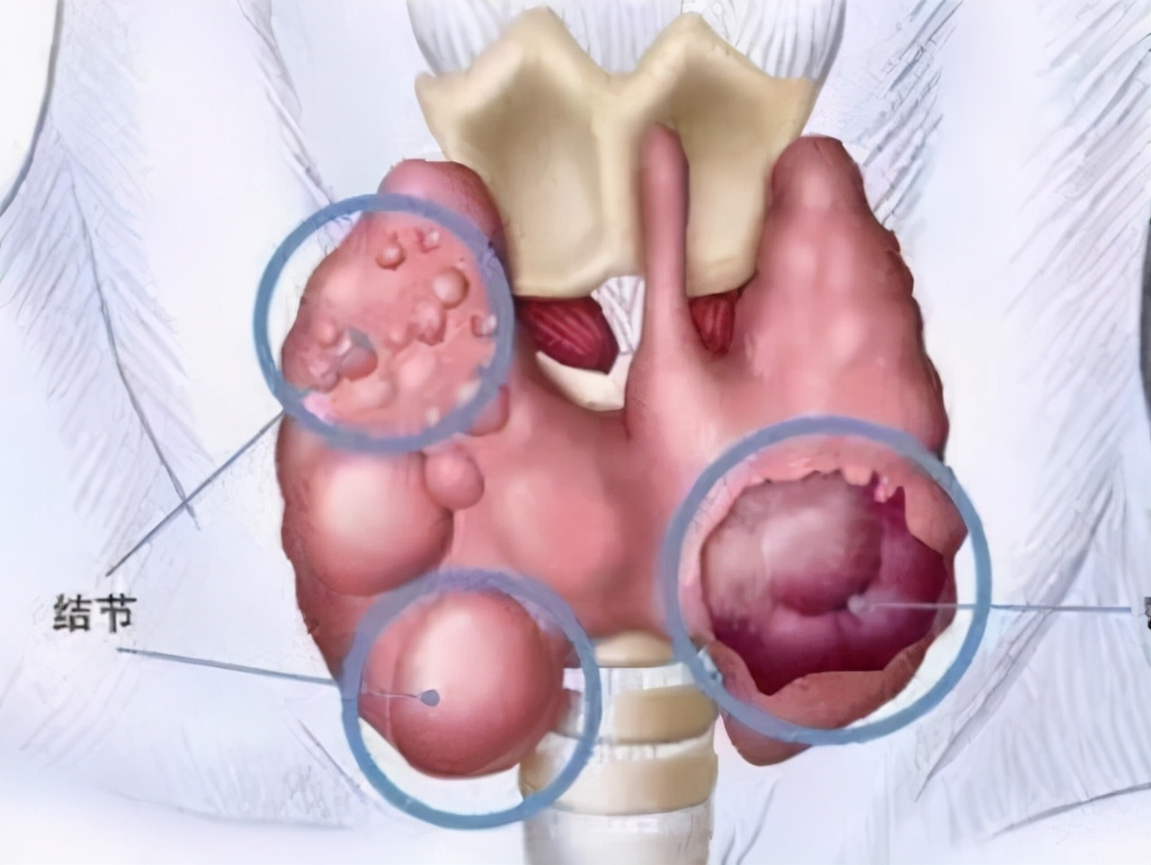 结节不用做手术，吃药就能好？这些情况需要注意