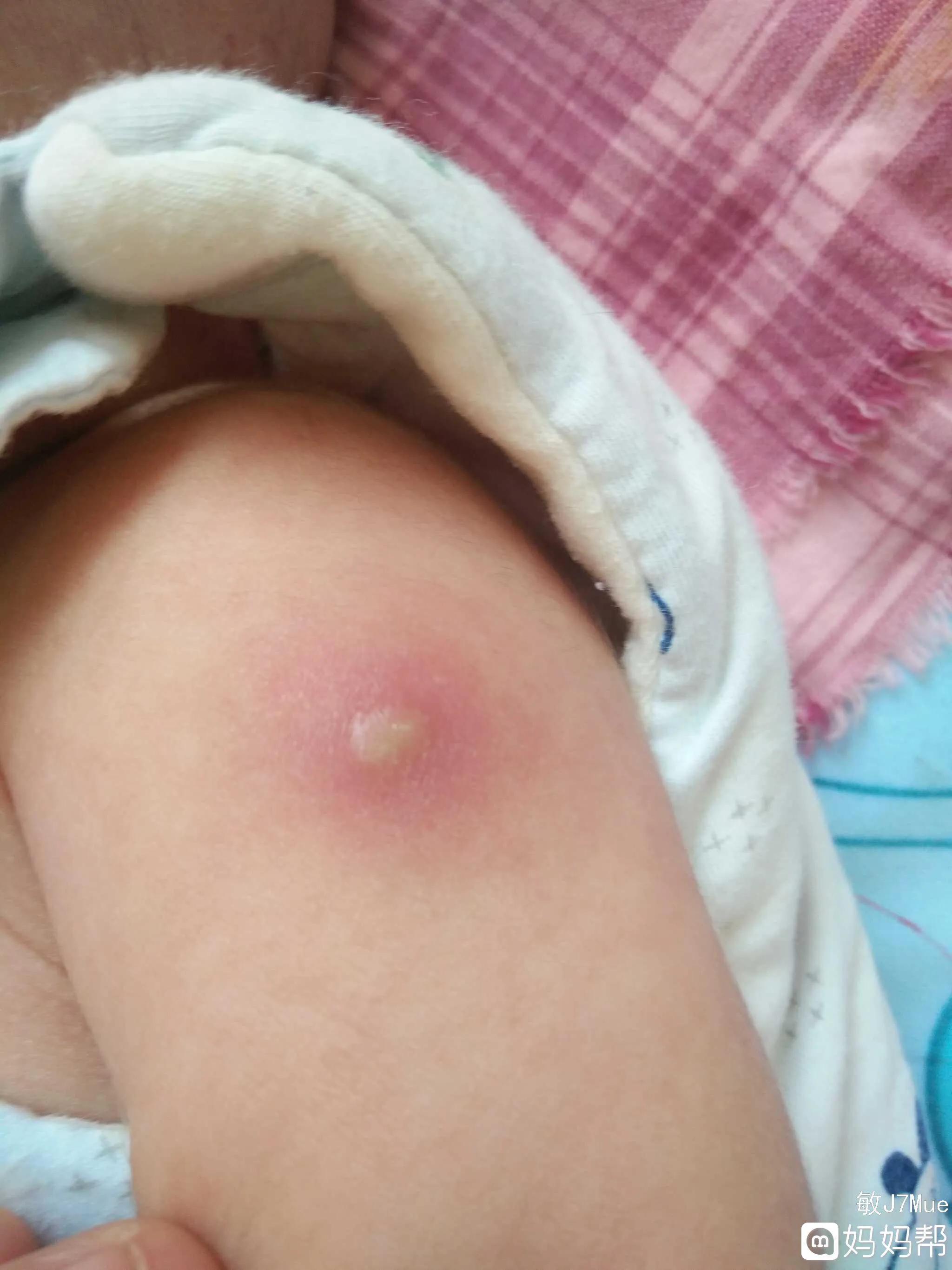 刚打完新冠疫苗应注意什么,儿童打完新冠疫苗注意什么