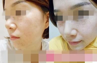 一次脸部微整形换来五年修复路,面部微整形美容前后对比