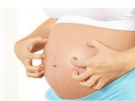 产后妊娠纹发痒怎么可以缓解,产后肚子上的妊娠纹长红点特别痒