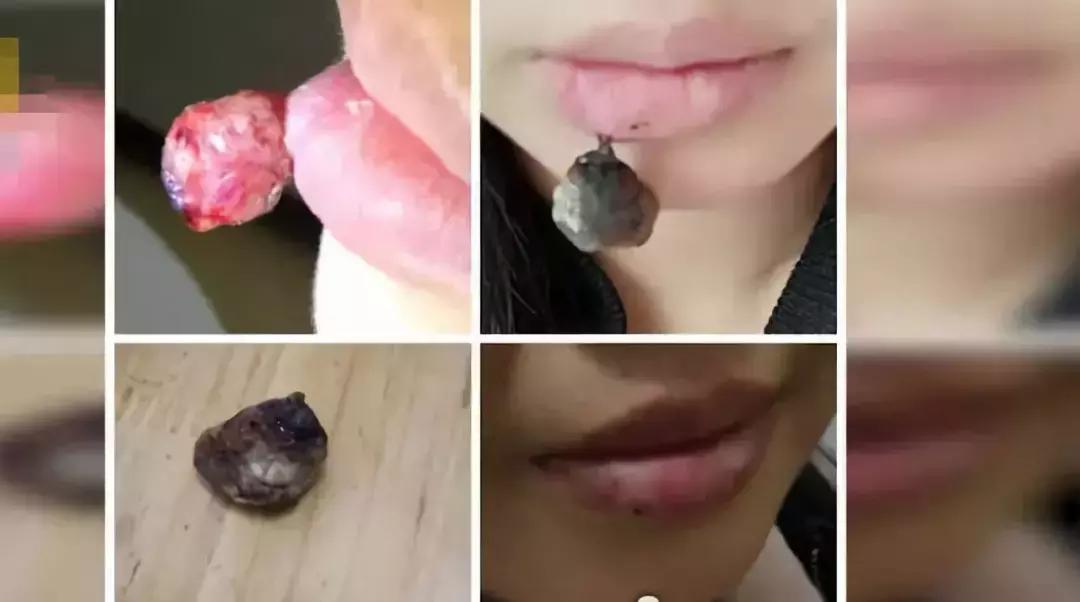 怀孕嘴巴里长血管瘤的女人,怀孕后嘴唇上长血管瘤