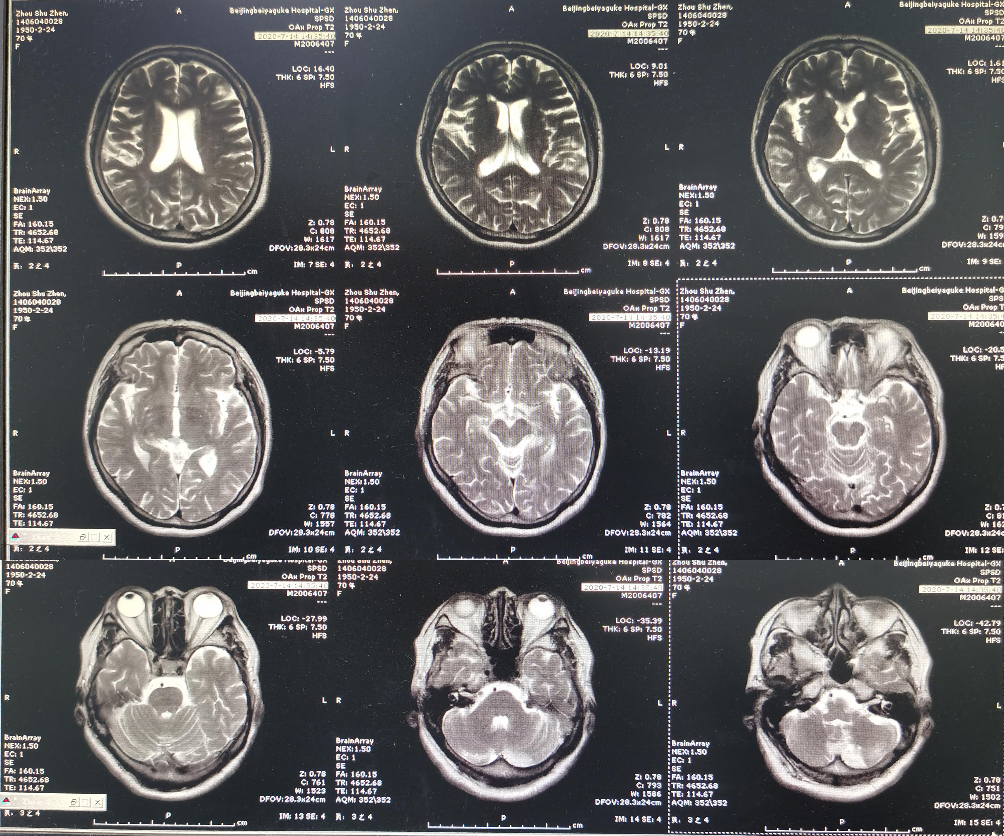 颈椎术后脑脊液漏取什么体位,脊髓型颈椎病手术后植骨愈合时间
