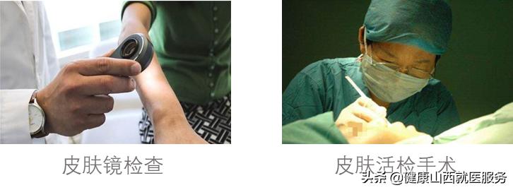 人老了长老年斑怎么回事,为什么年龄小长老年斑