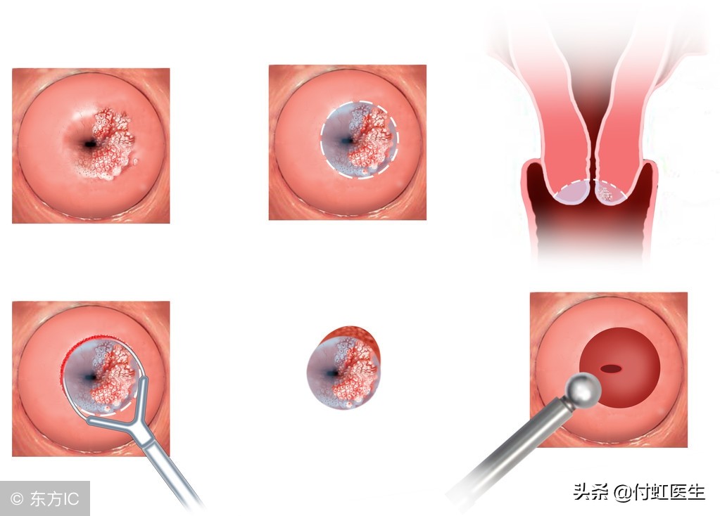 轻度宫颈糜烂辟谣,宫颈糜烂不是病还用治疗吗