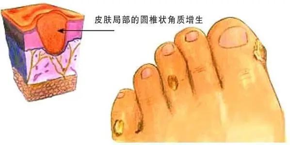 厦门女子把鸡眼药水当“眼药水”，差点失明