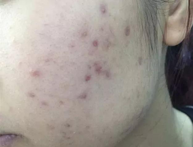 祛痘和祛痘印的方法一样吗,祛痘和祛痘印最好的方法是什么