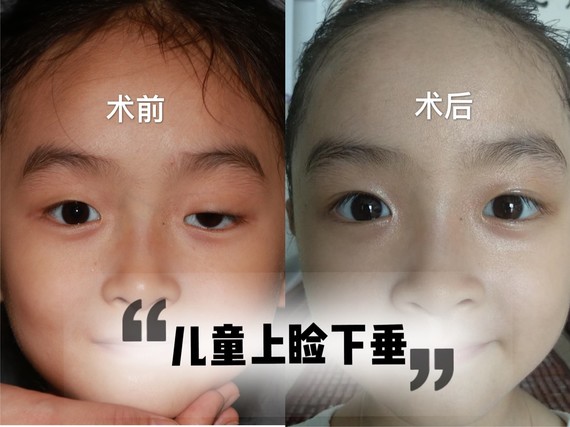 儿童上睑下垂最严重是哪种,儿童上睑下垂需要做很多次吗