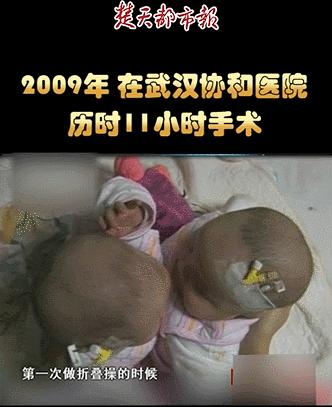 坐骨连体双胞胎多大分离,中国首例坐骨婴儿手术成功完整版