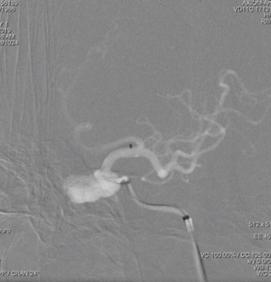 颈内动脉c3段动脉瘤是什么症状,右颈内动脉c3段动脉瘤是什么意思